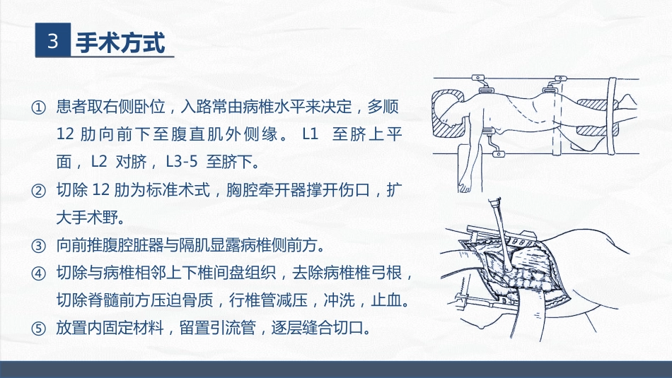 经前路腰椎手术护理配合_第14页