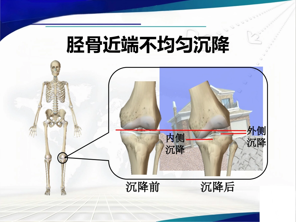 胫骨平台不均匀沉降_第8页