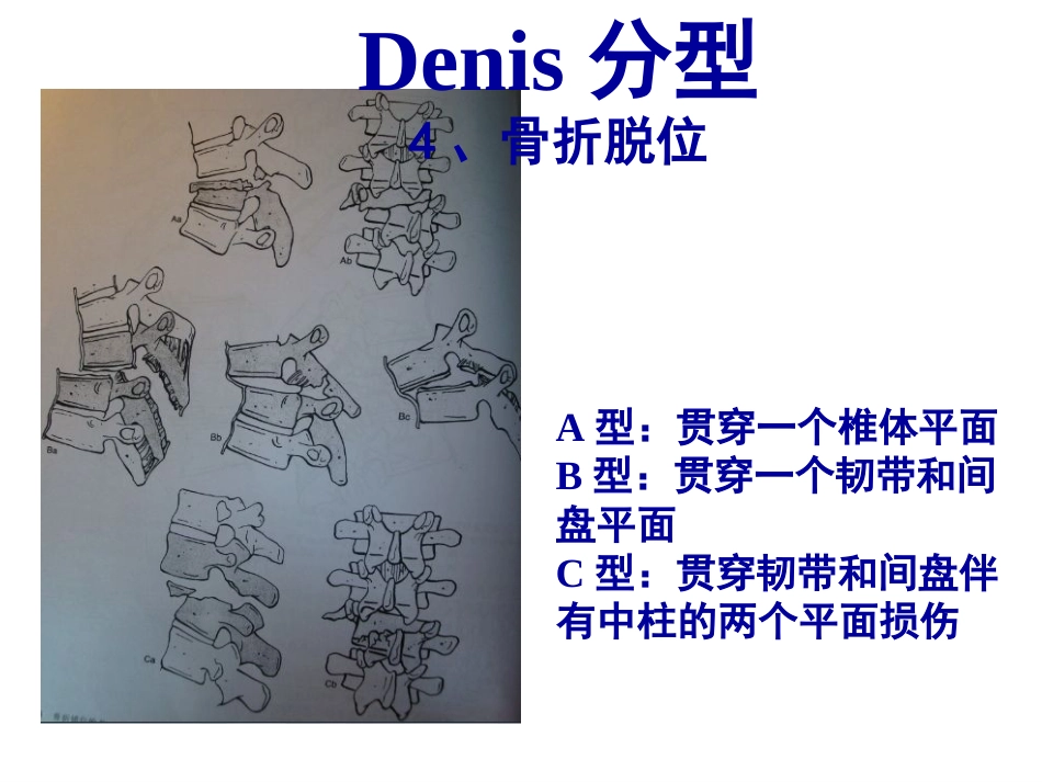 胸腰段脊柱骨折内固定范围的选择_第13页