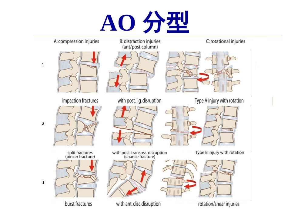 胸腰段脊柱骨折内固定范围的选择_第14页