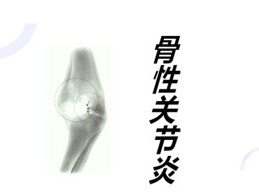 中医骨伤科学骨性关节炎部分PPT课件