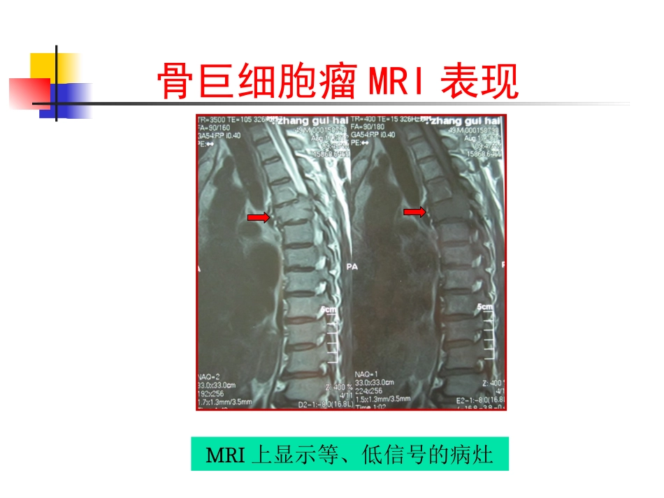 脊柱肿瘤诊断_第14页