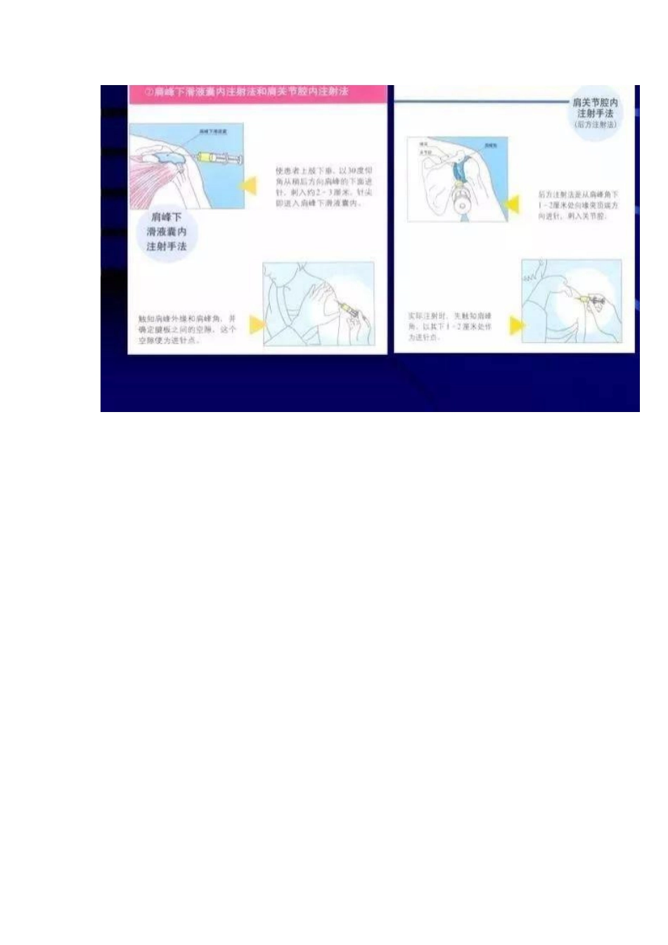 各关节腔穿刺方法技巧大全_第7页