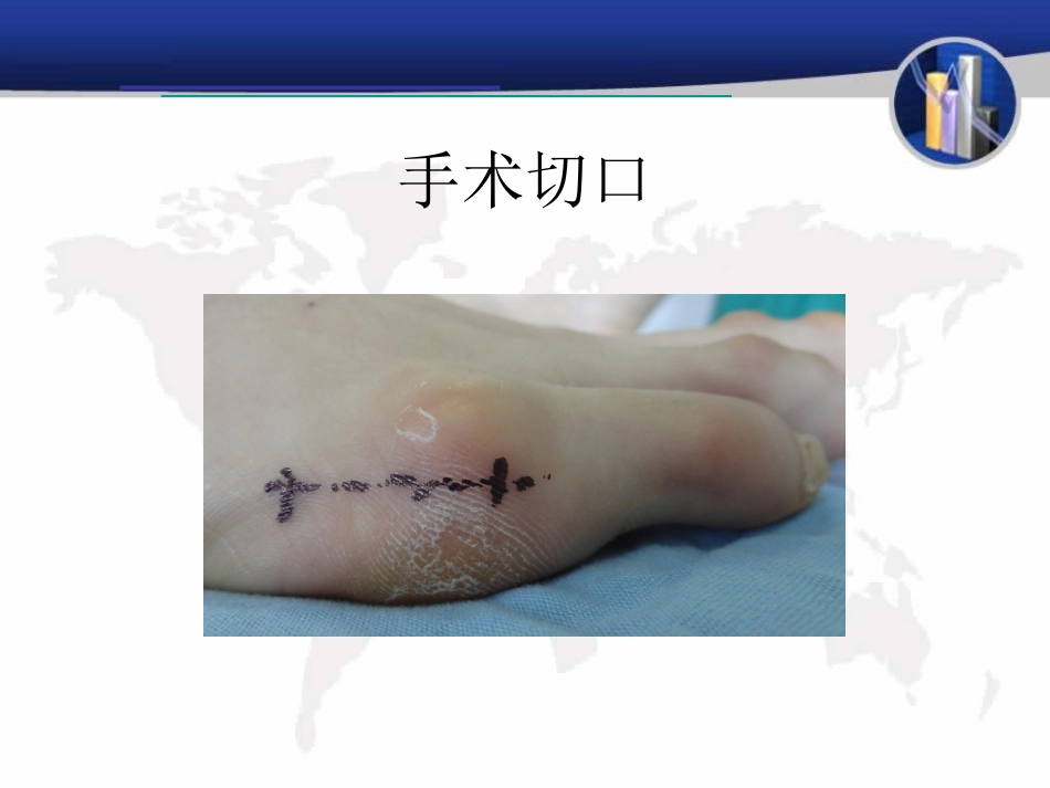 小趾囊炎_第12页