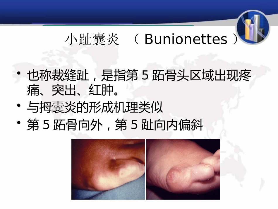 小趾囊炎_第2页