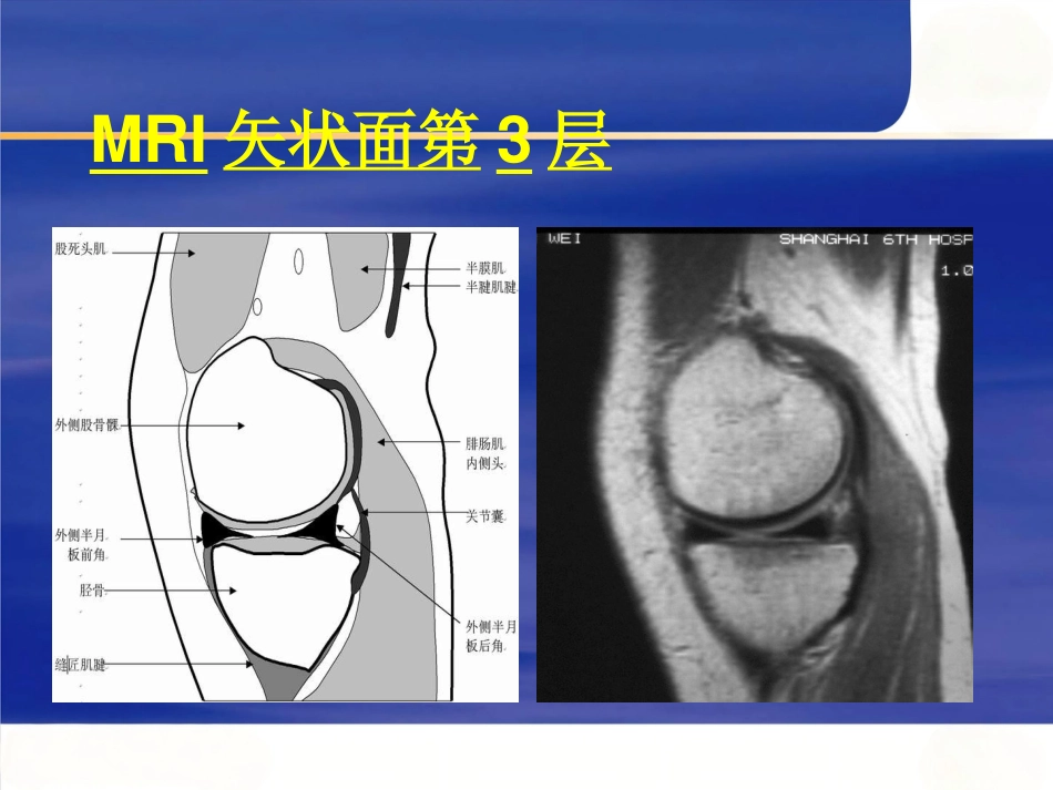 膝关节MRI_第7页