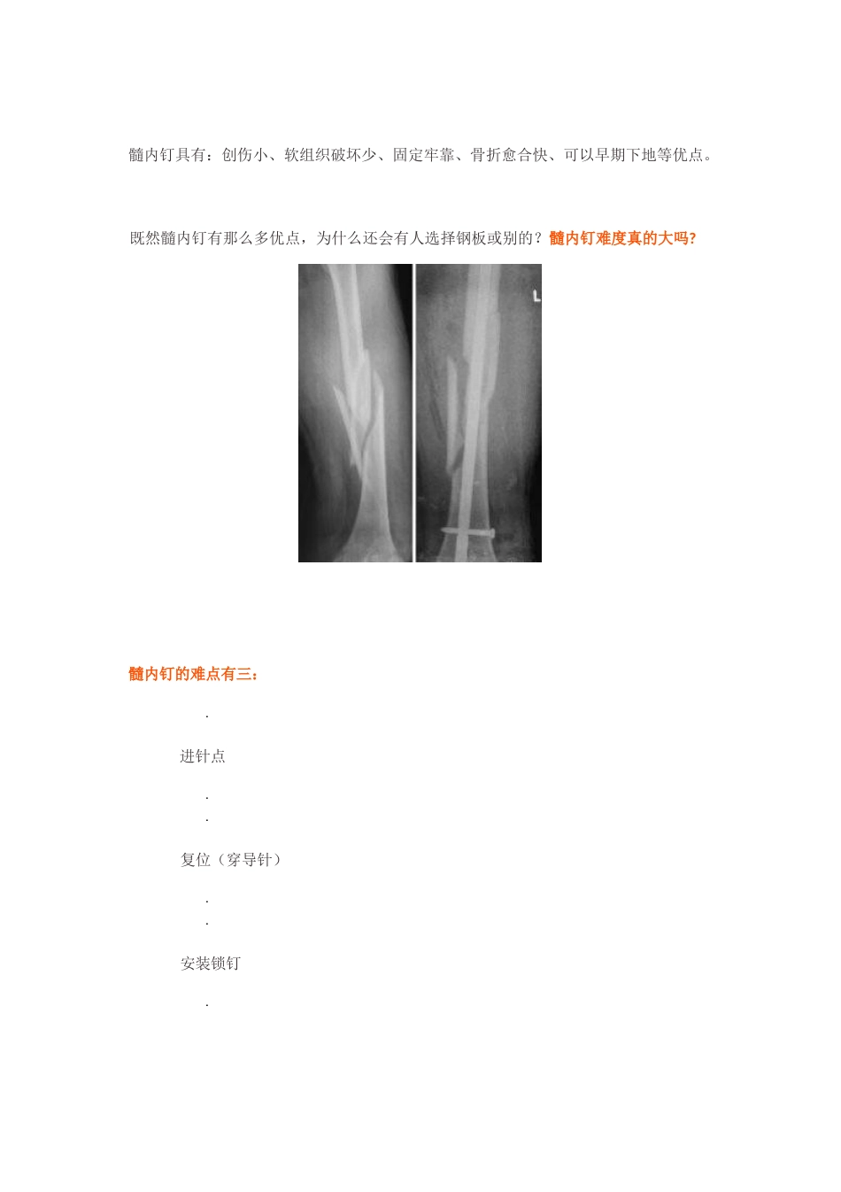 “金手指”在股骨干骨折闭合复位中的应用_第2页