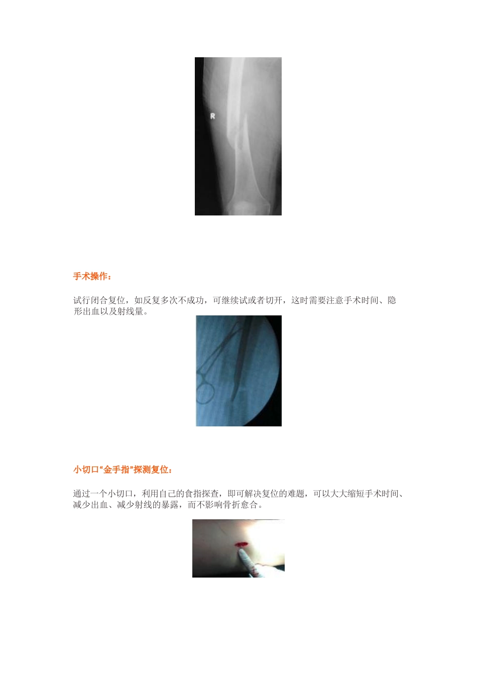 “金手指”在股骨干骨折闭合复位中的应用_第4页