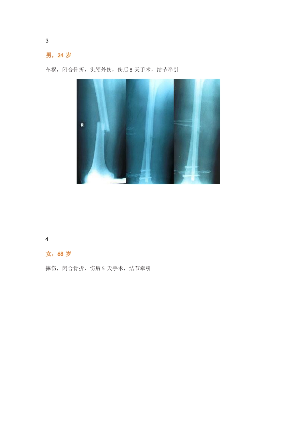 “金手指”在股骨干骨折闭合复位中的应用_第7页
