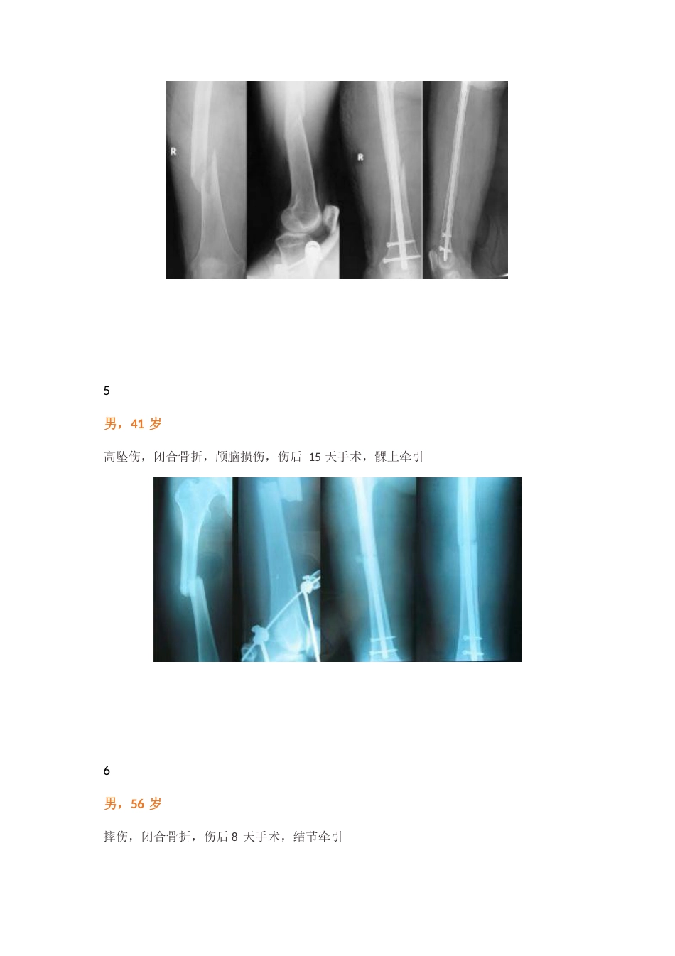 “金手指”在股骨干骨折闭合复位中的应用_第8页