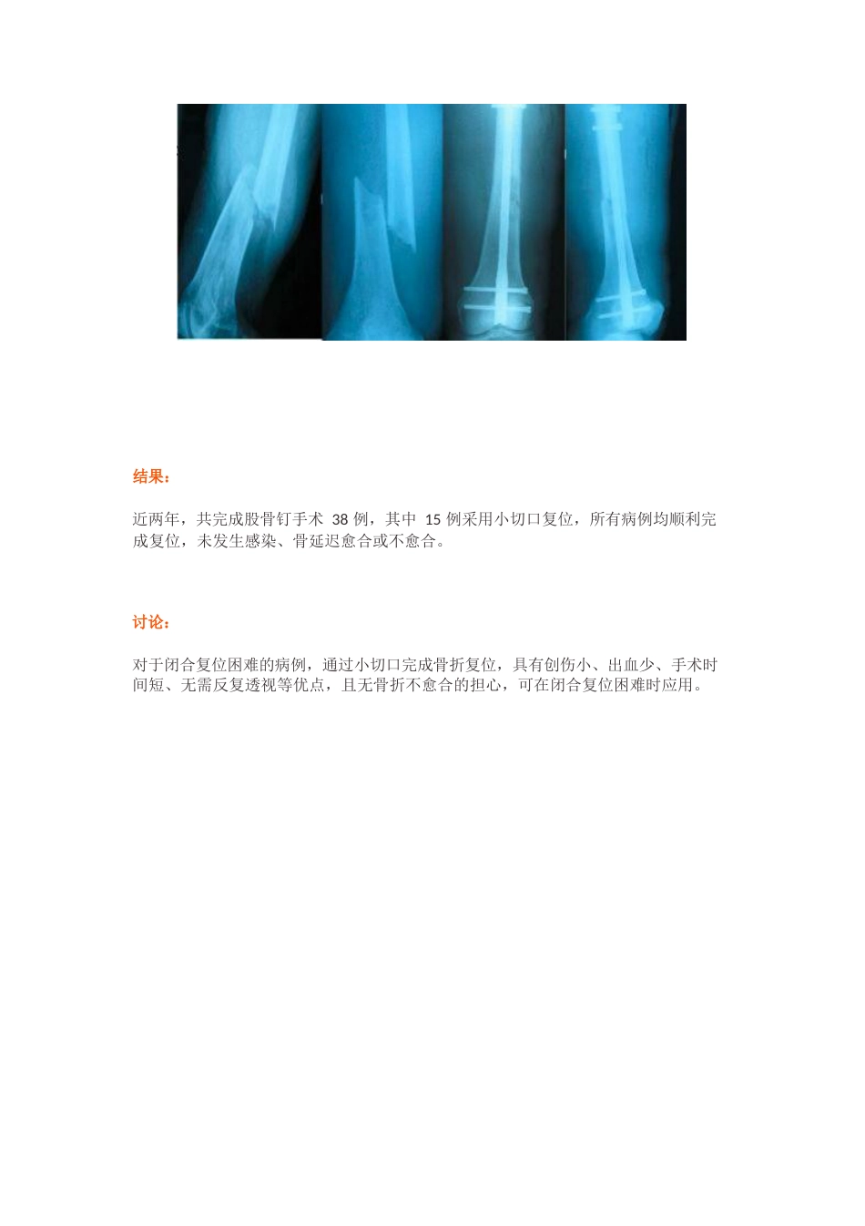 “金手指”在股骨干骨折闭合复位中的应用_第9页