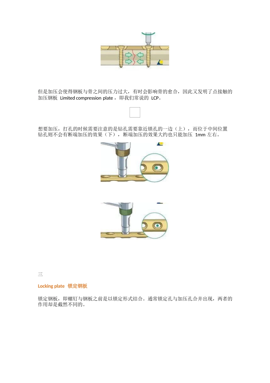 骨科最常用的钢板_第4页