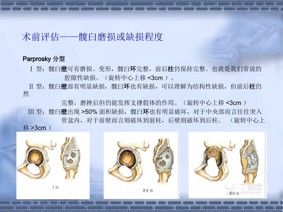 如何做好初次全髋关节置换_第13页