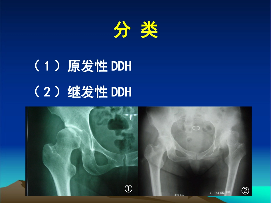 复杂性髋关节THA系列一_第6页