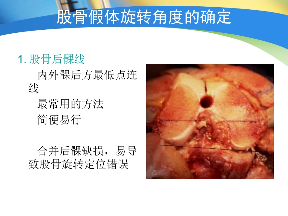全膝关节置换术力线_第14页