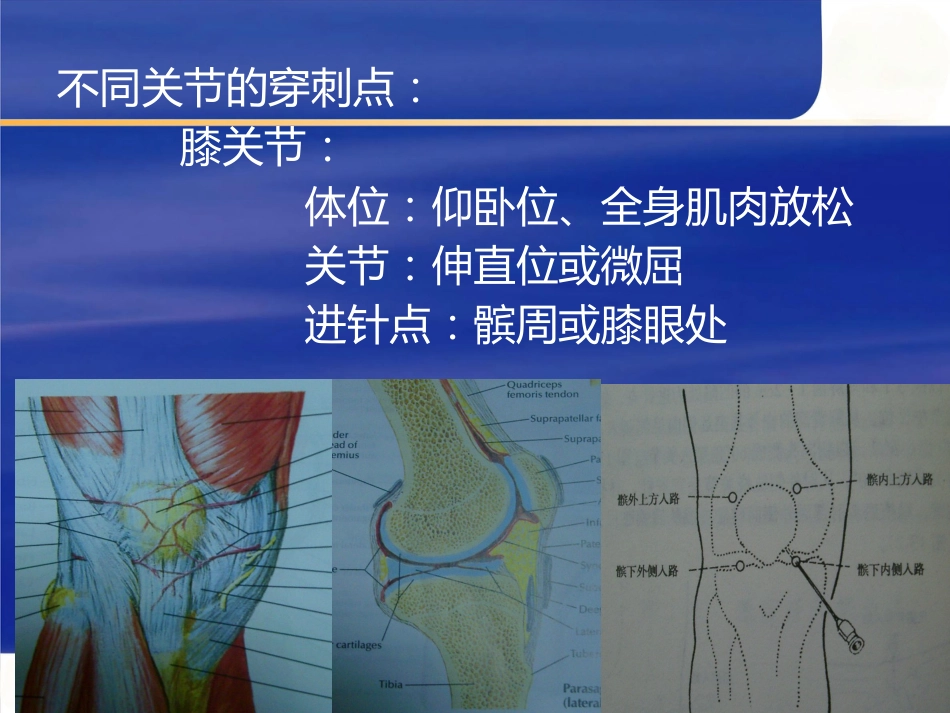 关节穿刺术二_第4页