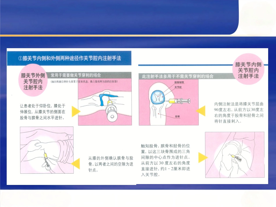 关节穿刺术二_第5页