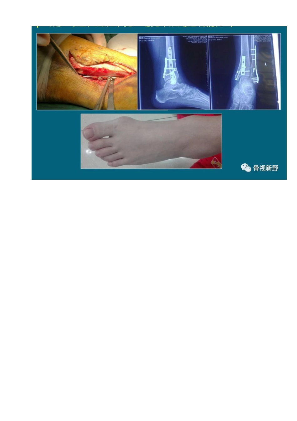 前外+后内侧手术入路治疗三踝骨折_第12页