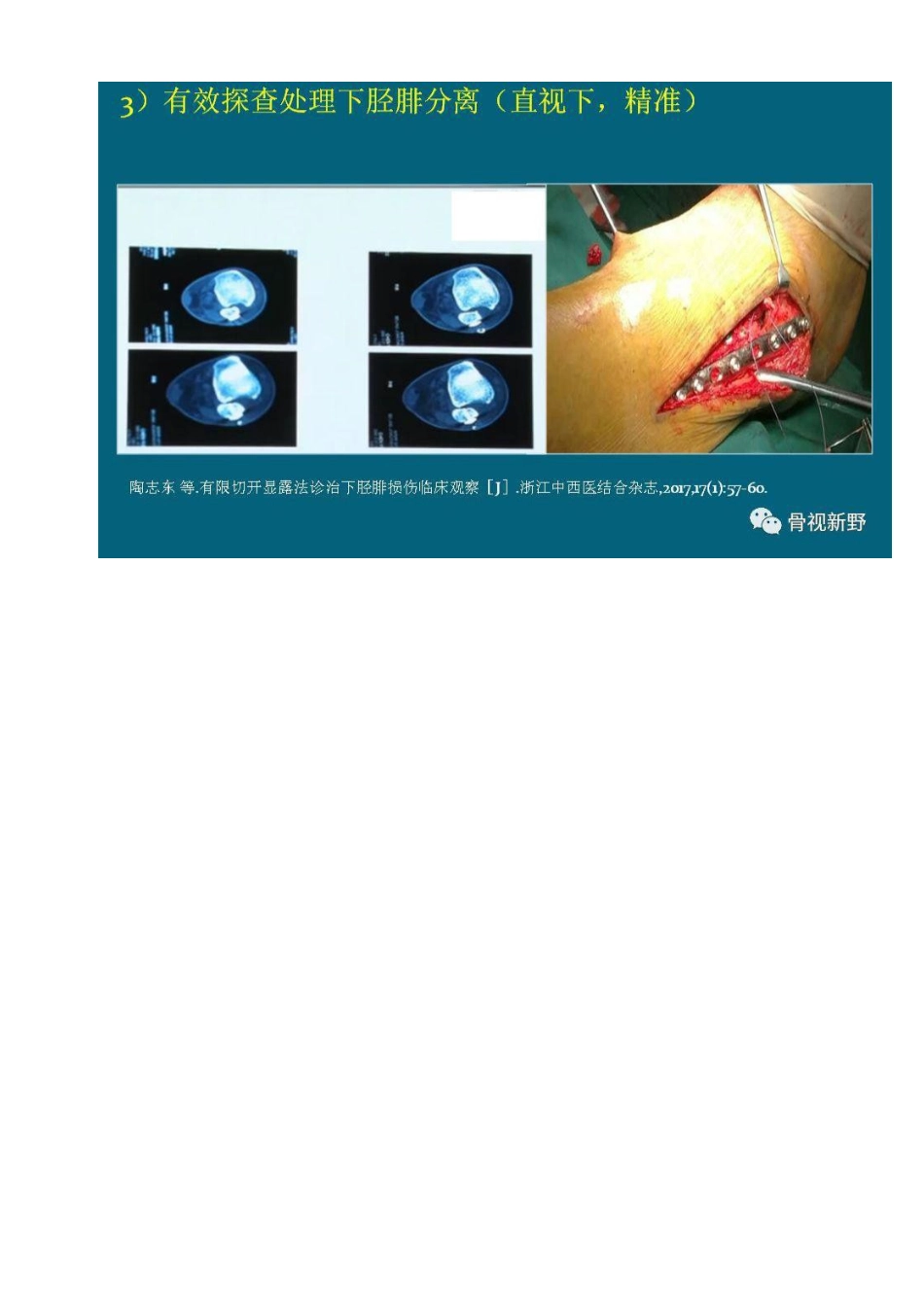 前外+后内侧手术入路治疗三踝骨折_第4页