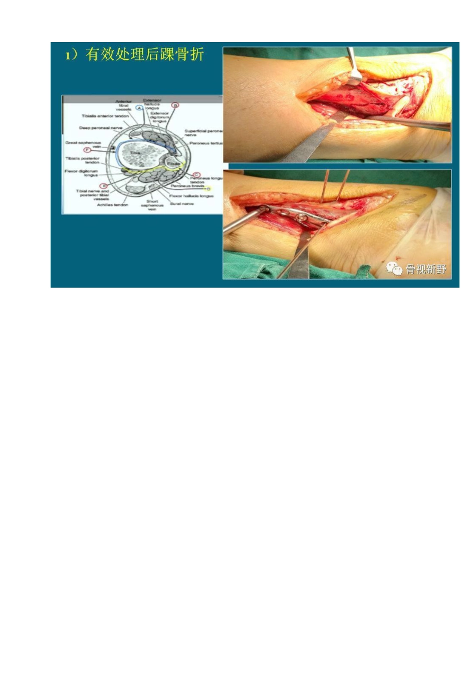 前外+后内侧手术入路治疗三踝骨折_第6页