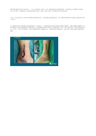 前外+后内侧手术入路治疗三踝骨折