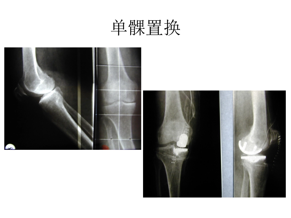 膝关节单髁置换_第3页