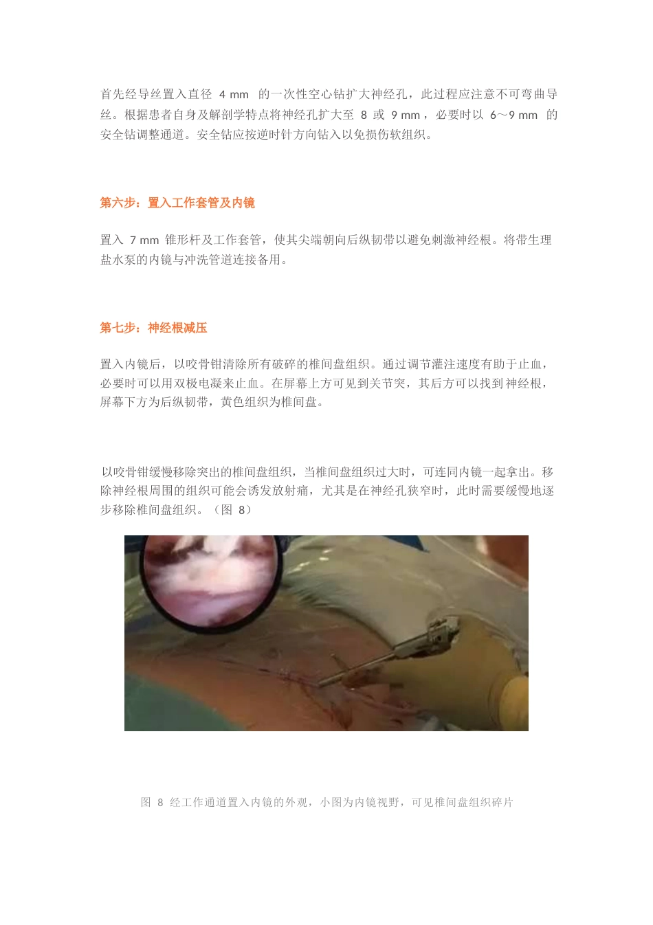 经皮椎间孔镜椎间盘切除术_第10页