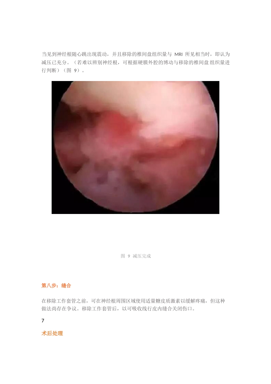 经皮椎间孔镜椎间盘切除术_第11页
