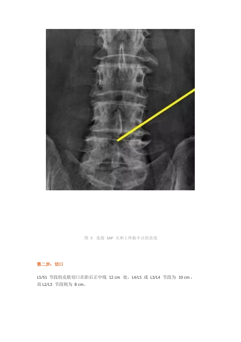 经皮椎间孔镜椎间盘切除术_第7页