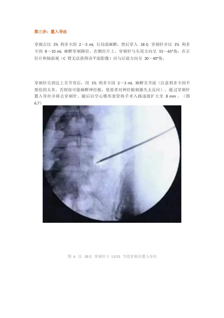经皮椎间孔镜椎间盘切除术_第8页