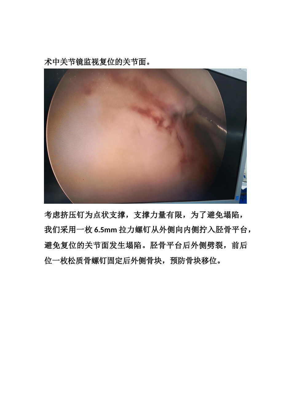 胫骨平台塌陷手术_第10页