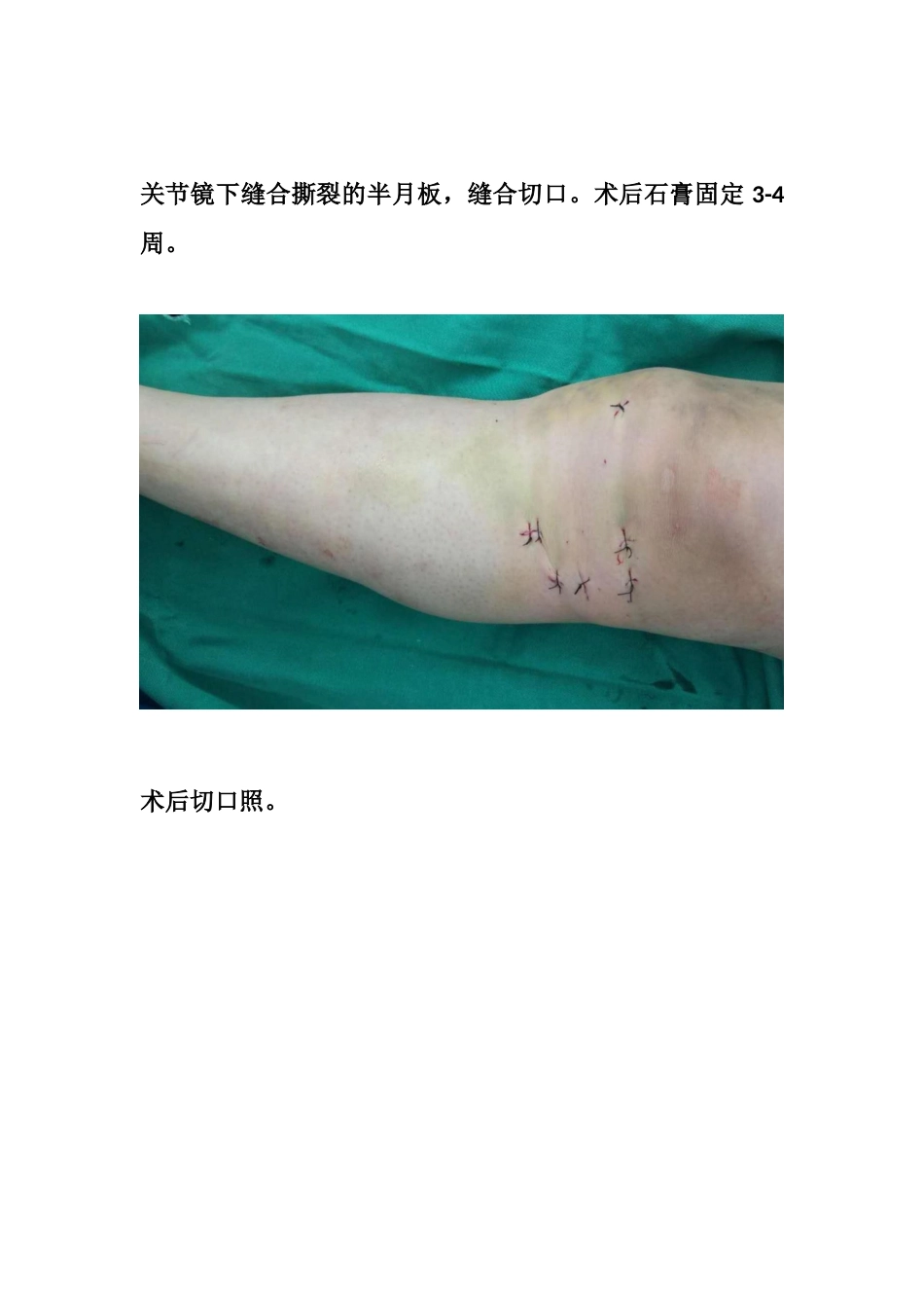 胫骨平台塌陷手术_第12页
