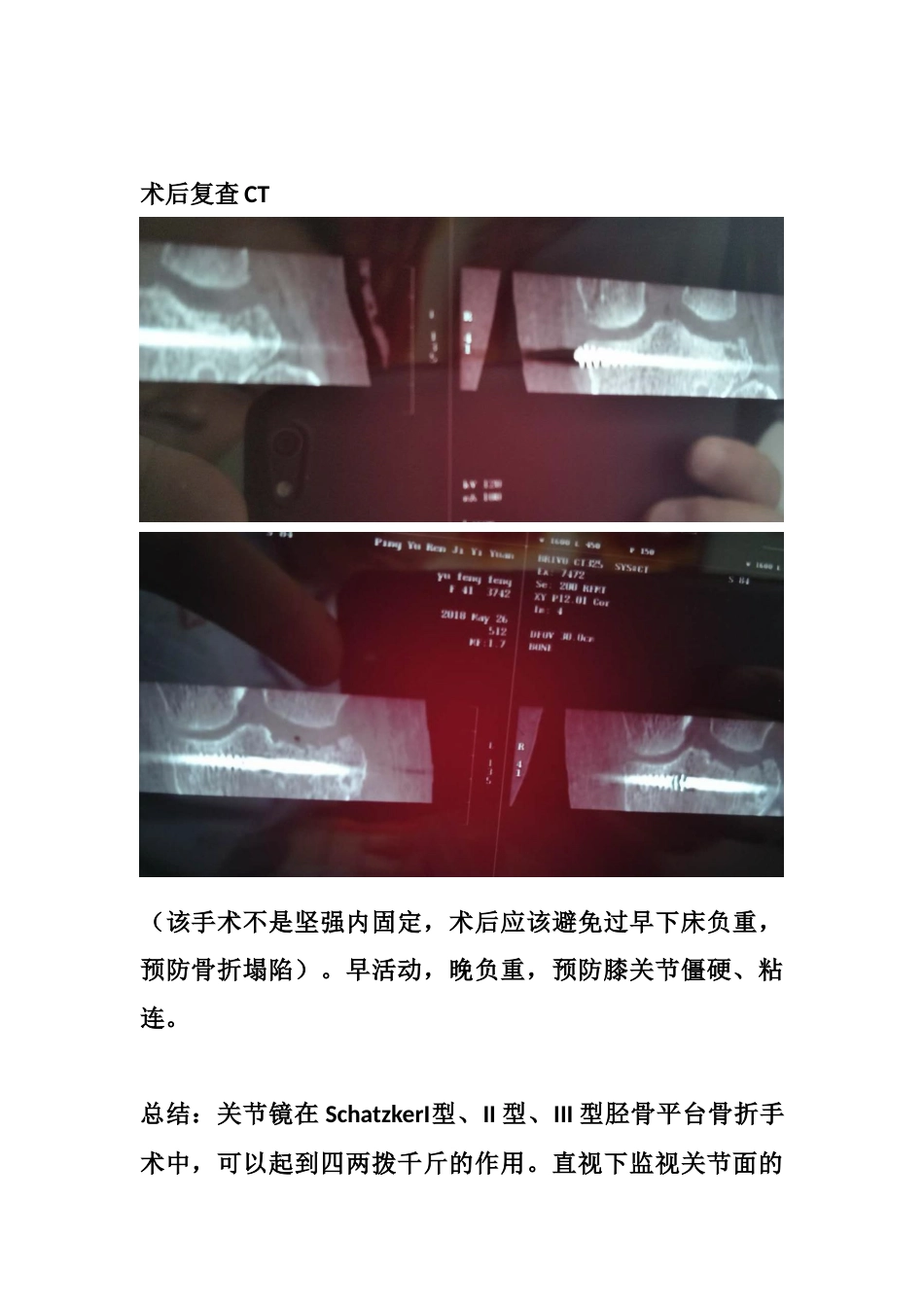胫骨平台塌陷手术_第13页