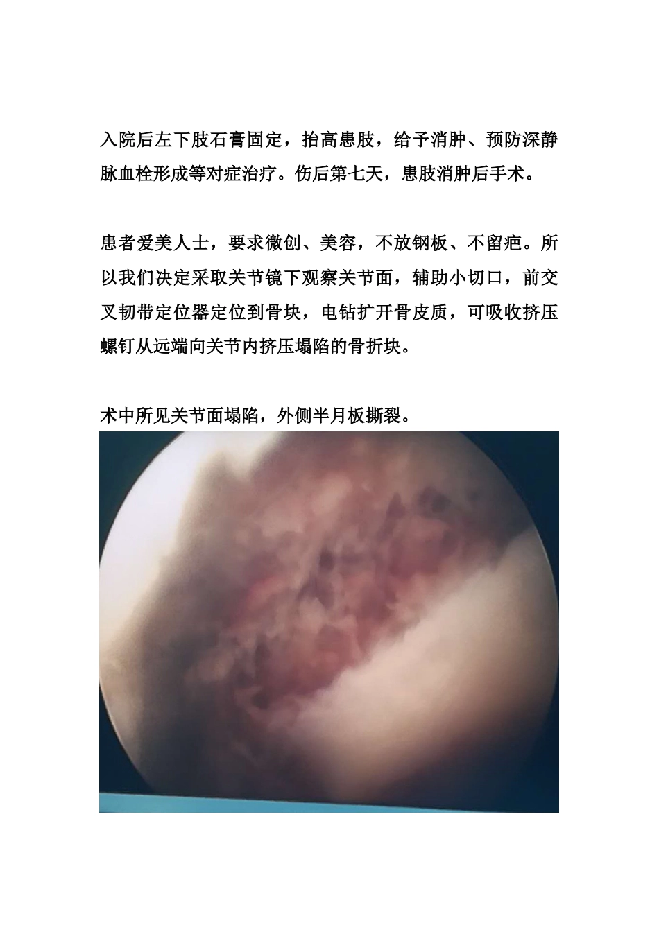 胫骨平台塌陷手术_第6页