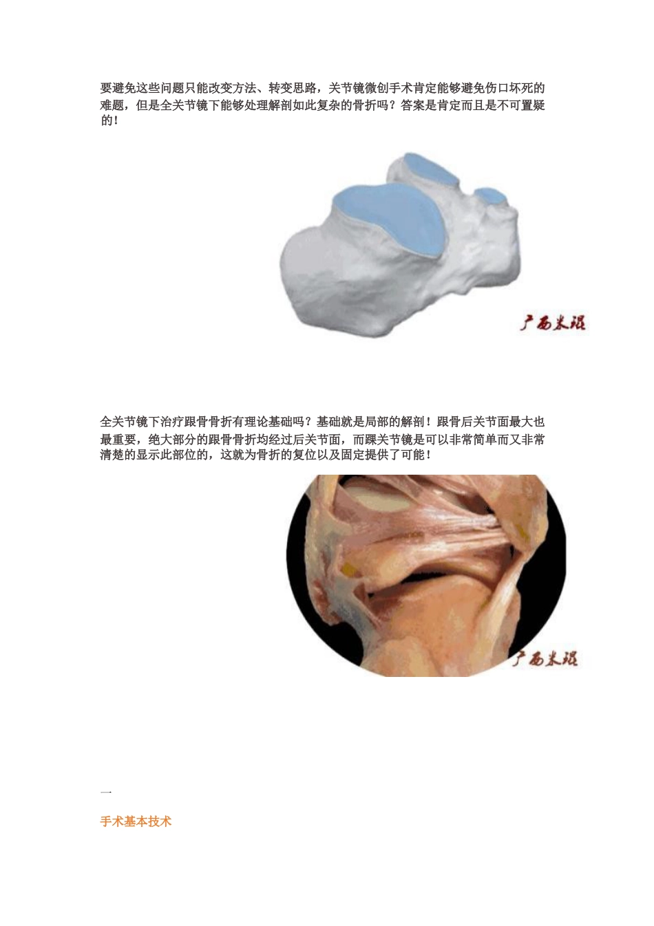 全关节镜下治疗跟骨骨折_第2页
