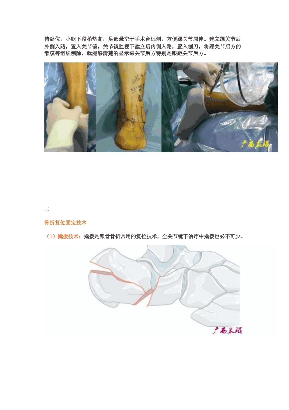 全关节镜下治疗跟骨骨折_第3页