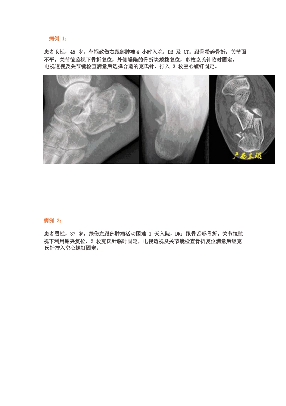 全关节镜下治疗跟骨骨折_第5页