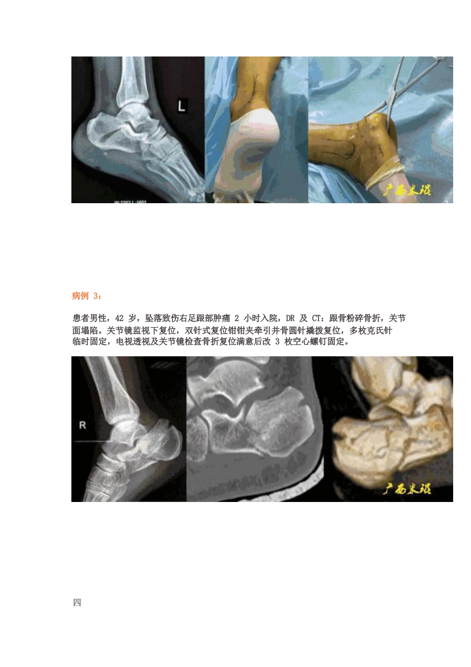 全关节镜下治疗跟骨骨折_第6页