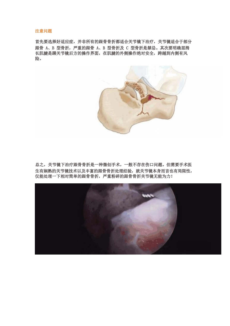 全关节镜下治疗跟骨骨折_第7页