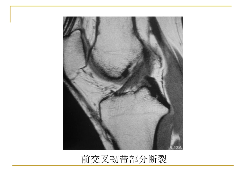 膝关节损伤MRI诊断问题分析_第10页