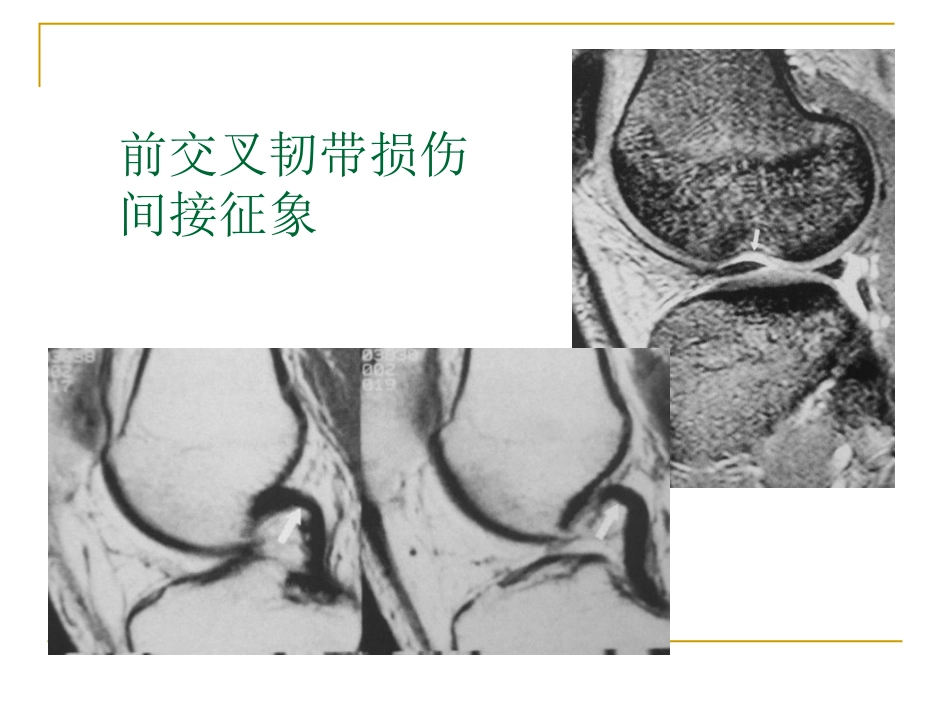 膝关节损伤MRI诊断问题分析_第13页
