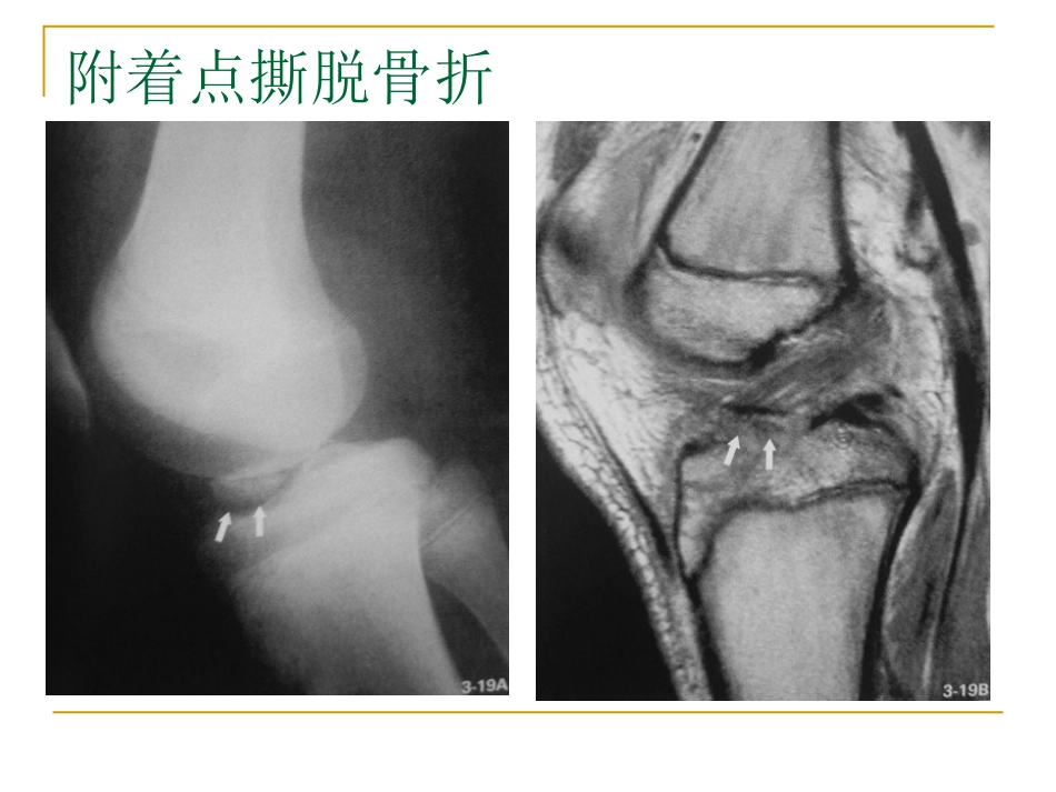 膝关节损伤MRI诊断问题分析_第14页