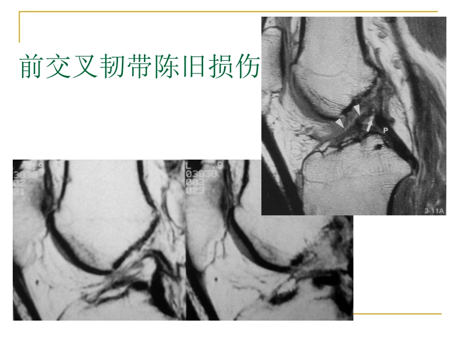 膝关节损伤MRI诊断问题分析_第15页