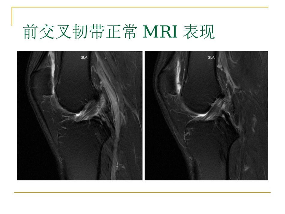 膝关节损伤MRI诊断问题分析_第6页