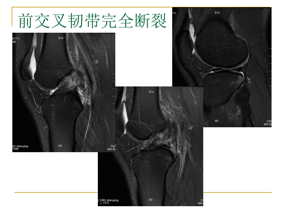 膝关节损伤MRI诊断问题分析_第7页
