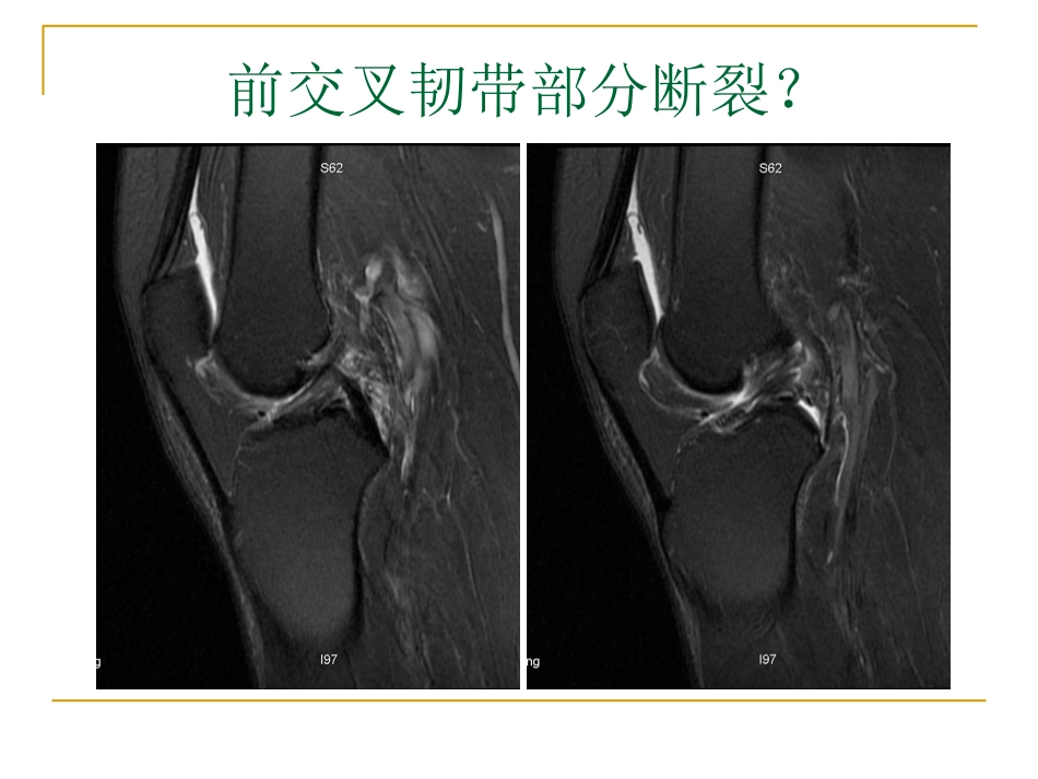 膝关节损伤MRI诊断问题分析_第8页