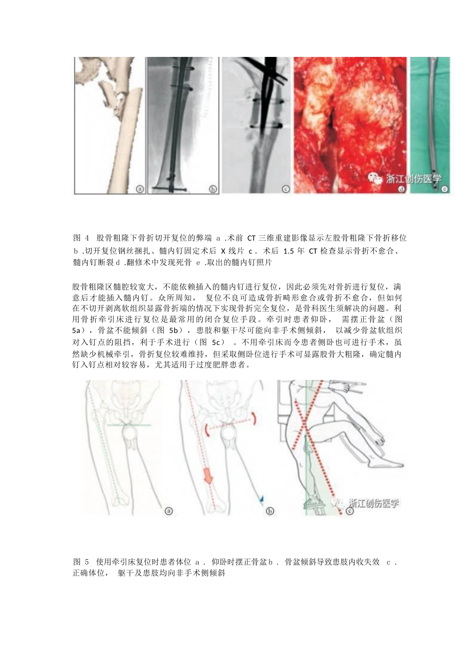 股骨粗隆下骨折髓内钉固定的复位技术_第3页