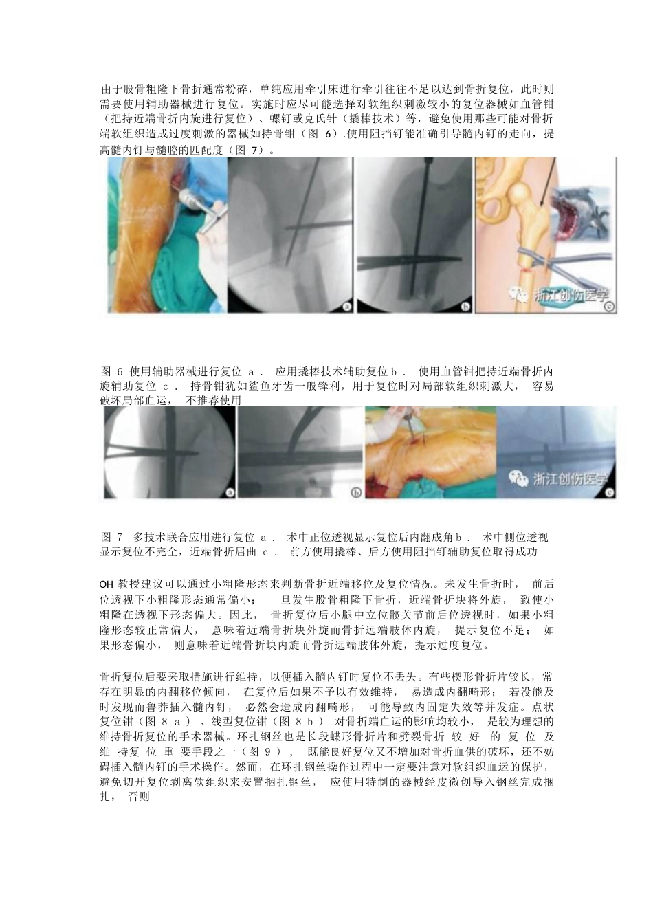 股骨粗隆下骨折髓内钉固定的复位技术_第4页