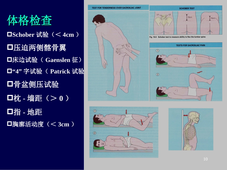 强直性脊柱炎ppt课件_第10页