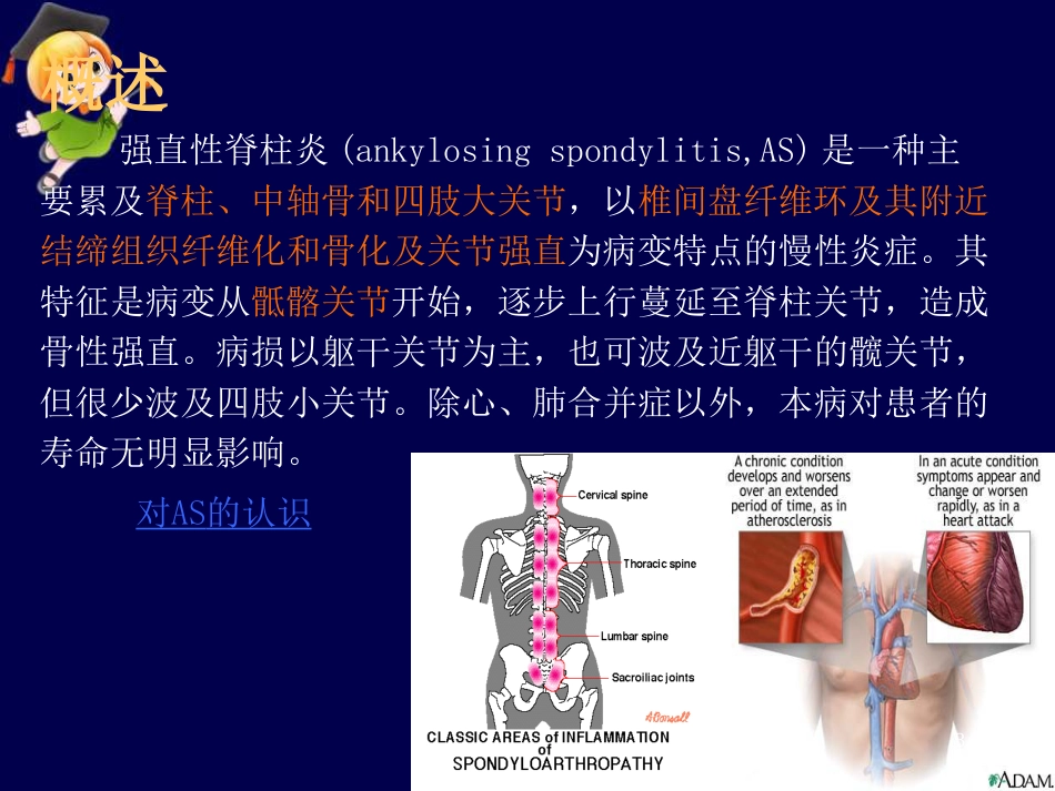 强直性脊柱炎ppt课件_第3页